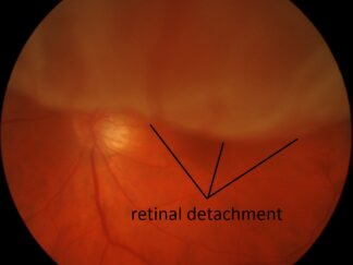 Retinal Detach big labeled3