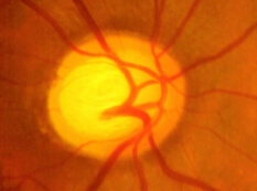 chronic open angle glaucoma MI 01AFTF17 1024x731 1