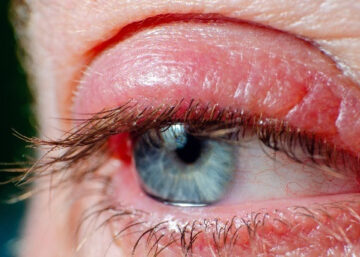 dry eye disease 8