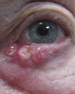 eyelid cancer