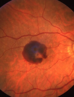 macular degeneration